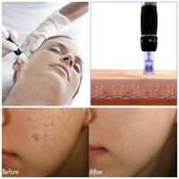 Microneedling