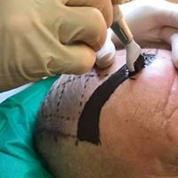 (Scalp) tricopigmentatie basis opleiding