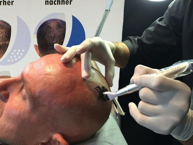 Scalp